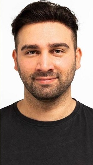 بعد از کاشت موی سر با خط رویش طبیعی در موآفرید