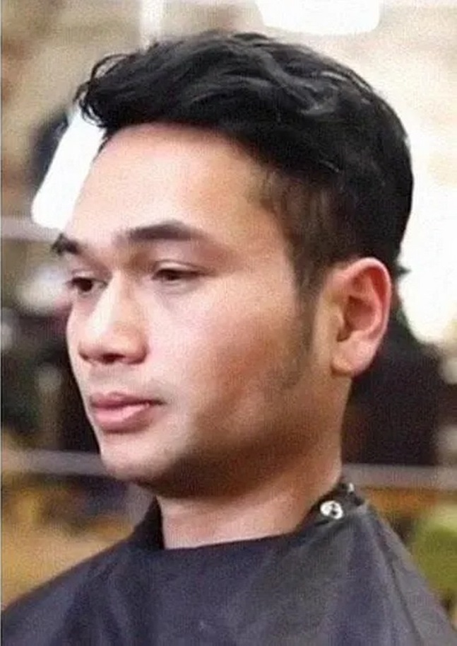 نتیجه کاشت مو با تراکم بالا در رشت - بعد