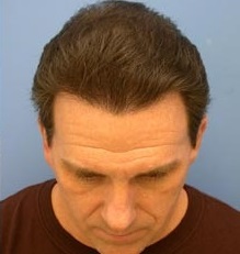 نتیجه نهایی و رضایتبخش کاشت مو در گیلان