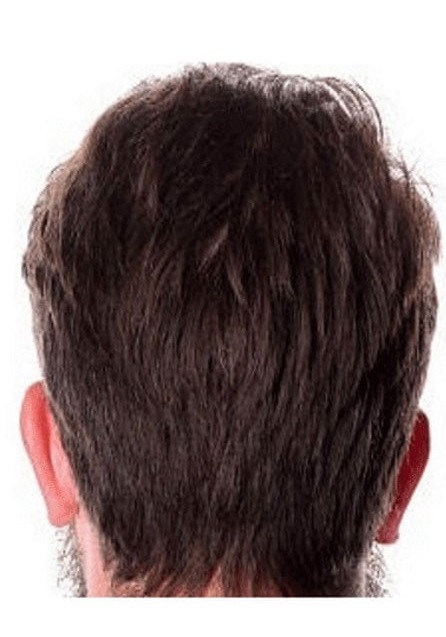 نمونه کار کاشت مو با نتیجه طبیعی در رشت - بعد