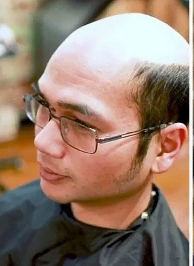 کاشت مو برای ناحیه جلوی سر - قبل