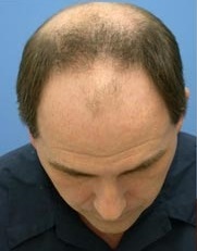 وضعیت موها قبل از مراجعه به موآفرید رشت