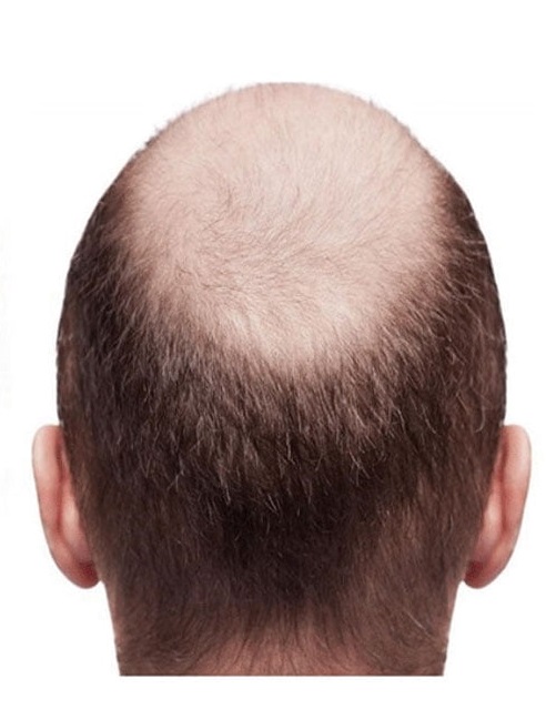 نمونه کار کاشت مو برای آقایان - قبل